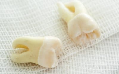 The Patient’s Guide to Wisdom Teeth Removal