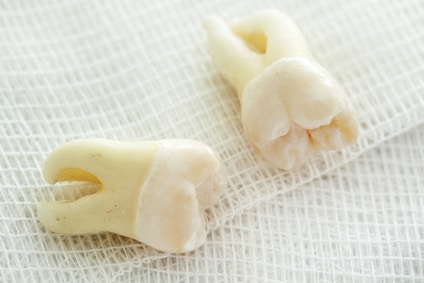 The Patient’s Guide to Wisdom Teeth Removal