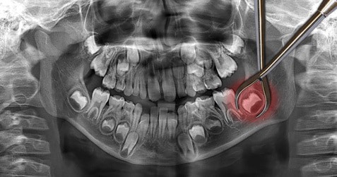 Do You Really Need Your Wisdom Teeth Removed?