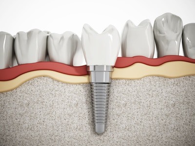 Dental Implants in Vancouver, what are dental implants