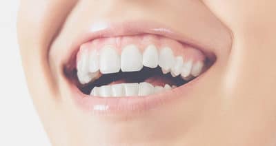 5 Things that Dental Veneers can Fix