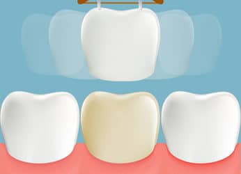 Understanding What Happens When You Get Dental Veneers