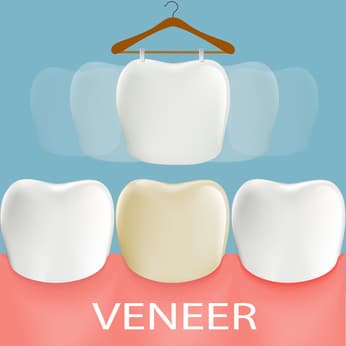 Dental veneers. Tooth anatomy. Stock vector illustration.