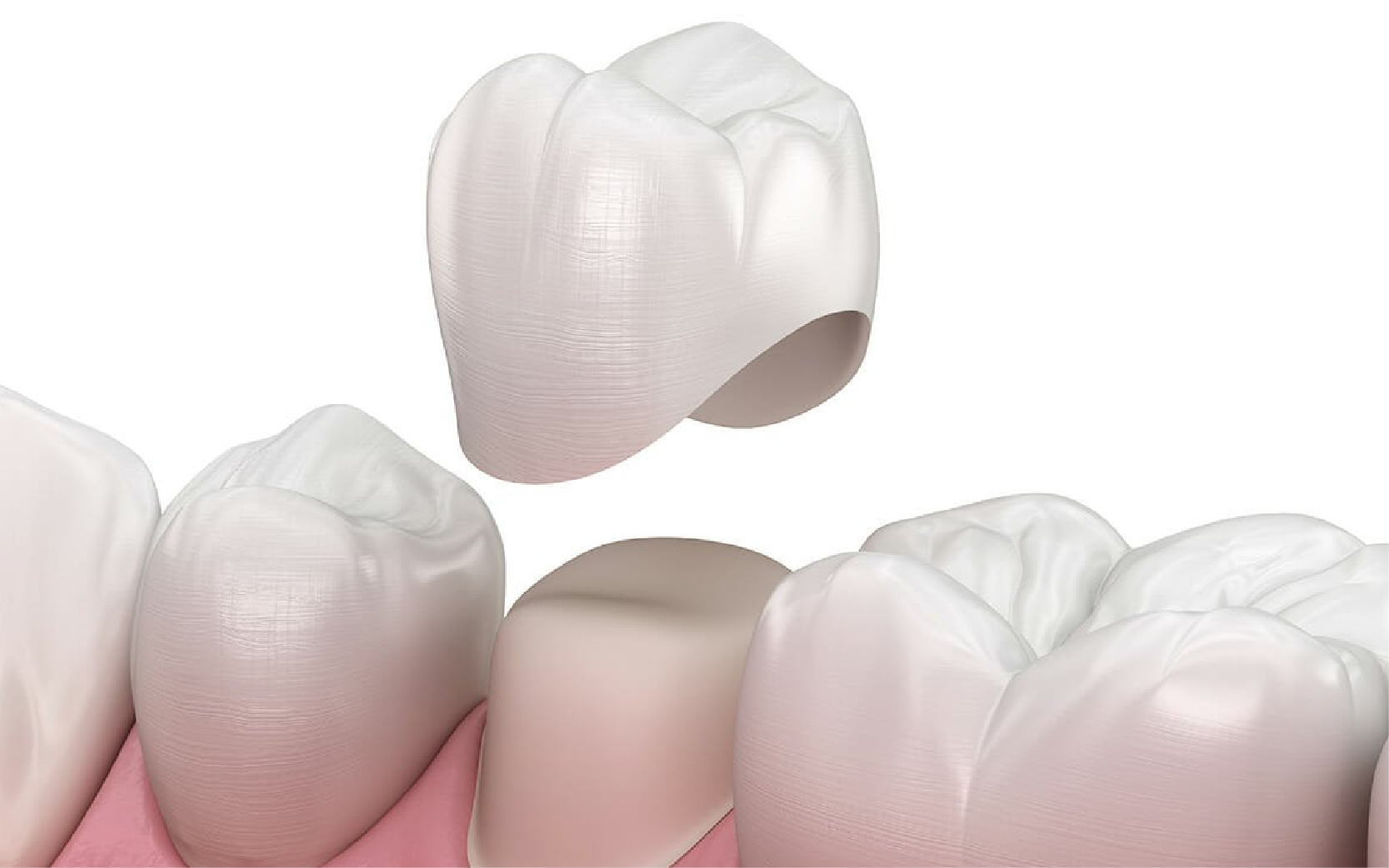 Dental Crowns