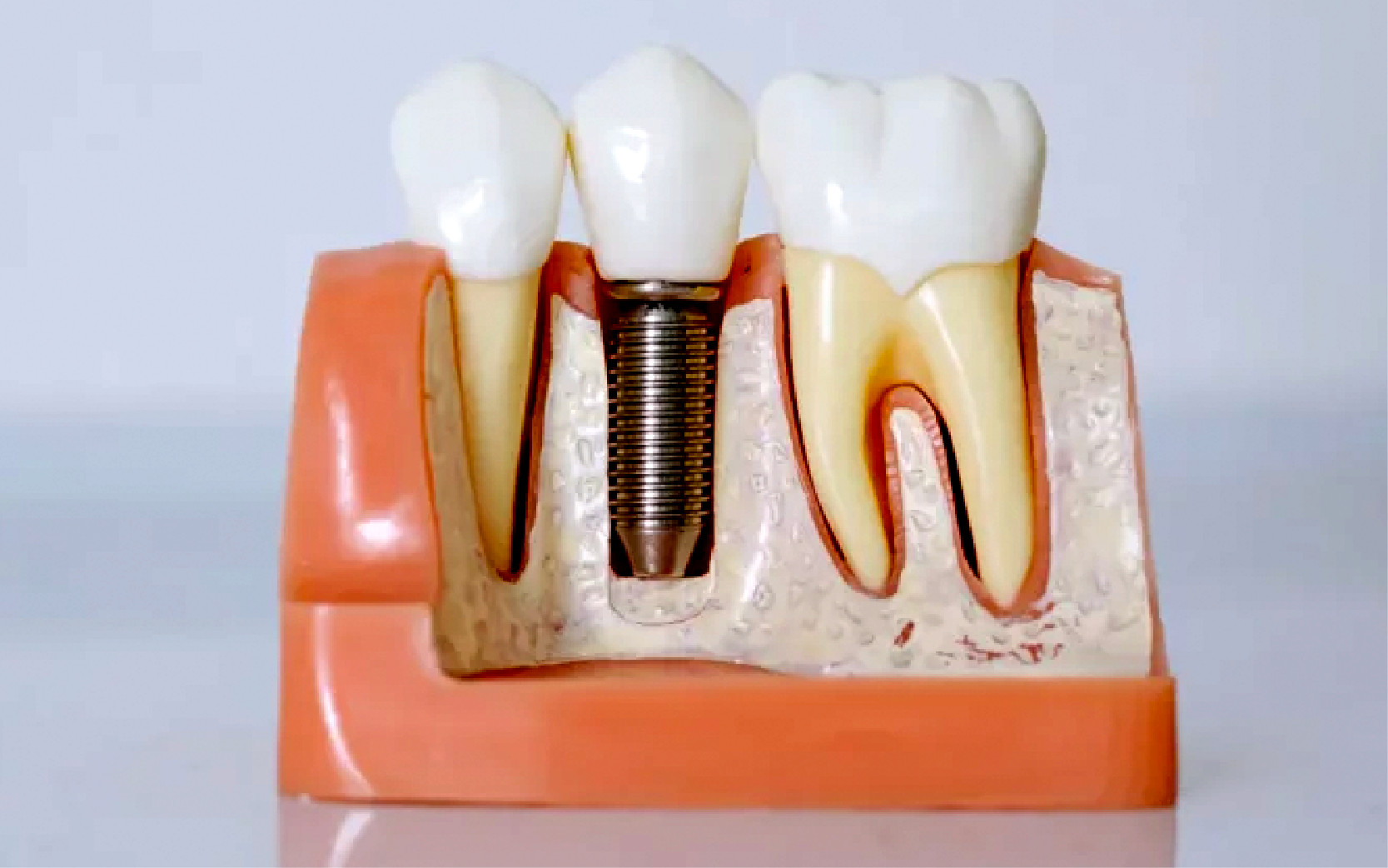 Services-DentalImplants