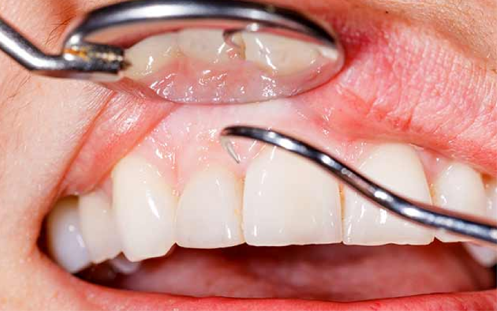 Periodontic Care